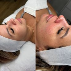 Antes y después Skin and soul (4)