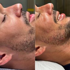 Antes y después Skin and soul