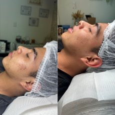 Antes y despues skin and soul 5