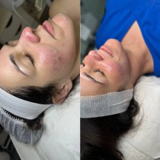 Antes y despues skin and soul 6