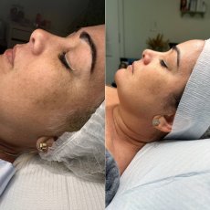 Antes y despues skin and soul 7