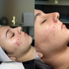 Antes y despues skin and soul 8